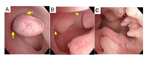 Hình minh họa các loại Polyp